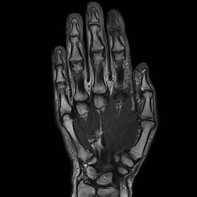 снимок МРТ суставов кисти руки